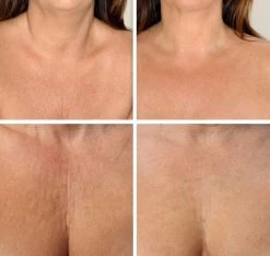 Simia™ Anti Rimpel Beauty Pads - Decolleté Large T Shape Set (2 Stuks) - Herbruikbaar Anti Aging Siliconen Pad Tegen Lijntjes En Slaaprimpels 10 Simia™ Anti Rimpel Beauty Pads - Decolleté Large T Shape Set (2 Stuks) - Herbruikbaar Anti Aging Siliconen Pad Tegen Lijntjes En Slaaprimpels -Cosmetic Verkoop 1200x1139