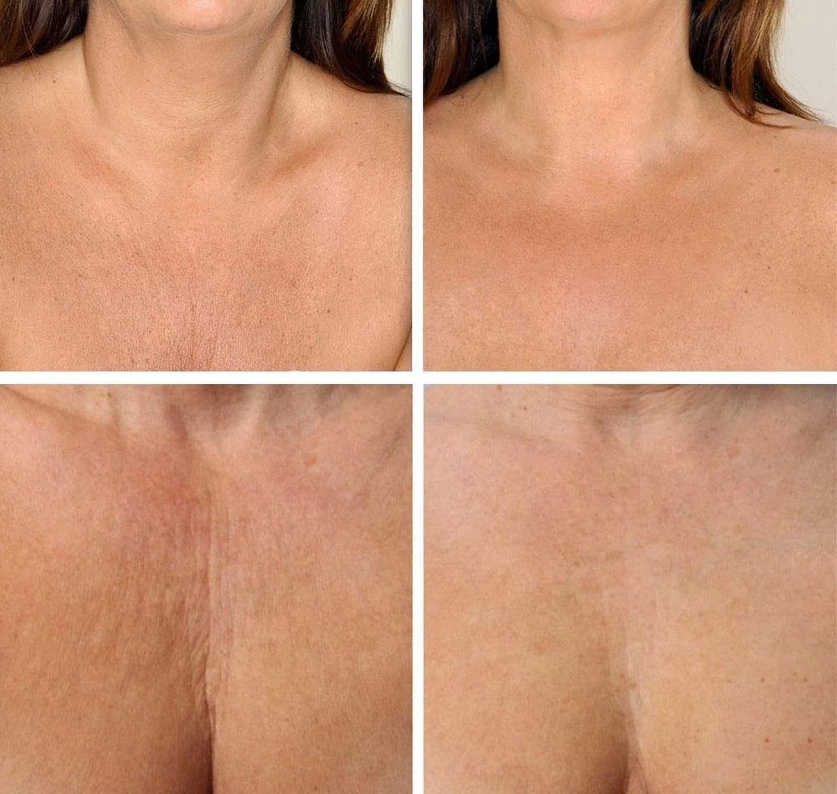 Simia™ Anti Rimpel Beauty Pads - Decolleté Large T Shape Set (2 Stuks) - Herbruikbaar Anti Aging Siliconen Pad Tegen Lijntjes En Slaaprimpels 5 Simia™ Anti Rimpel Beauty Pads - Decolleté Large T Shape Set (2 Stuks) - Herbruikbaar Anti Aging Siliconen Pad Tegen Lijntjes En Slaaprimpels - Afbeelding 4