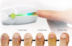 Anti Schimmelnagel Kalknagel Laserapparaat Om Zelf Te Behandelen, Veilig, Effectief, Snel En Pijnloos, Koude Laser Behandeling Voor Thuisgebruik, Voor Tenen En Vingers. Oplaadbaar. -Cosmetic Verkoop 1200x774